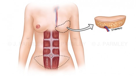 Breast Reconstruction: DIEP Flap Surgery